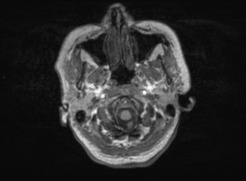 File:Bilateral PCA territory infarction - different ages (Radiopaedia 46200-51784 Axial T1 350).jpg
