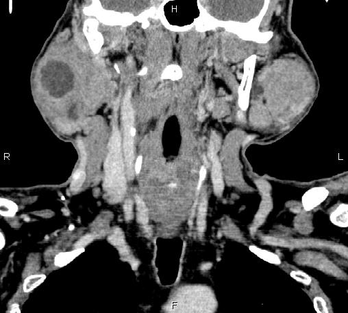 File:Bilateral Warthin tumors (Radiopaedia 84034-99263 C 26).jpg