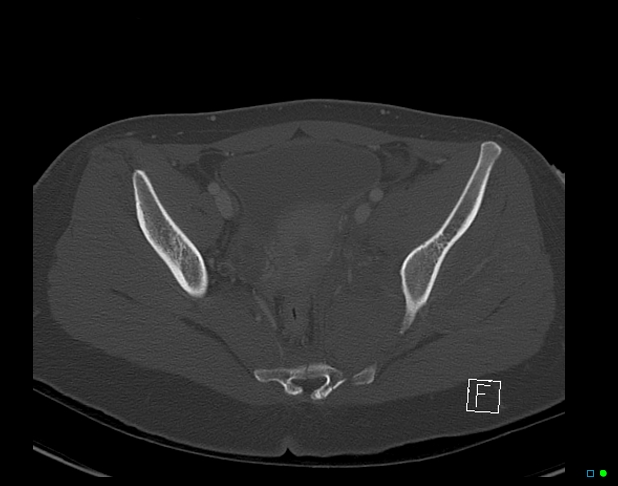 File:Bilateral acetabular fractures (Radiopaedia 79272-92308 Axial bone window 32).jpg