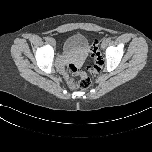 File:Bilateral acetabular protrusion with pincer type femoro-acetabular impingement (Radiopaedia 30134-30733 AXIAL SOFT THIN 22).jpg