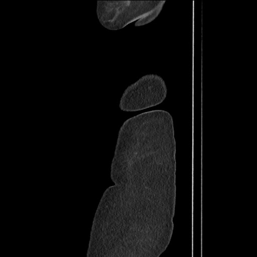File:Bilateral adrenal granulocytic sarcomas (chloromas) (Radiopaedia 78375-91007 C 12).jpg