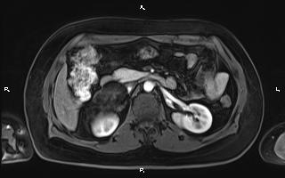Bilateral adrenal myelolipoma (Radiopaedia 63058-71537 Axial T1 C+ fat sat 46).jpg