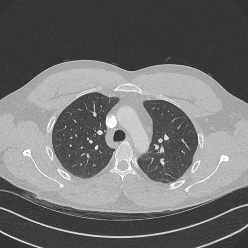 Bilateral atelectasis (Radiopaedia 48666-53675 Axial lung window 35).jpg