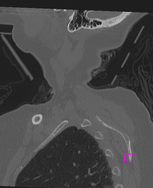 Bilateral atlanto-occipital assimilation (Radiopaedia 28350-28603 Sagittal bone window 3).jpg