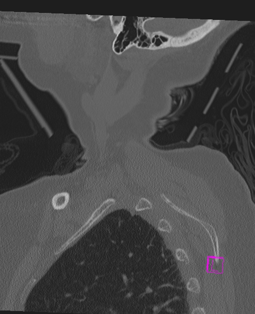 Bilateral atlanto-occipital assimilation (Radiopaedia 28350-28603 Sagittal bone window 4).jpg