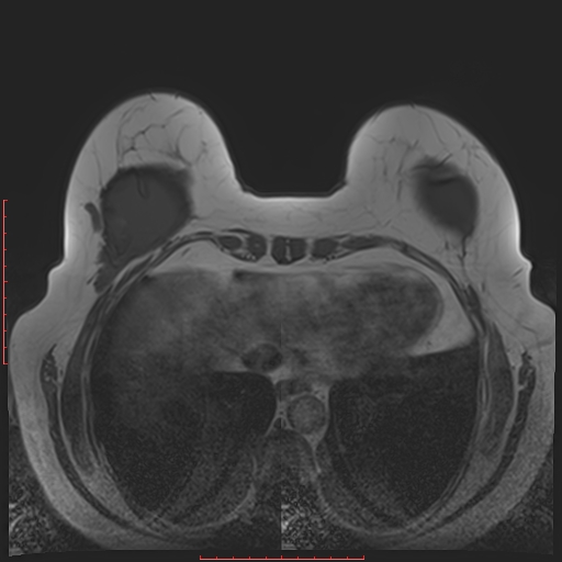 File:Bilateral breast implant rupture (Radiopaedia 24761-25027 T1 29).jpg