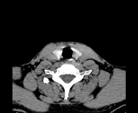 Bilateral carotid body tumors (Radiopaedia 61841-69870 Axial non-contrast 88).jpg