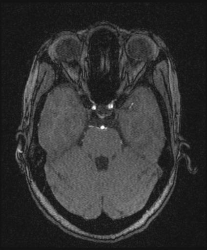 Bilateral carotid body tumors and right glomus jugulare tumor (Radiopaedia 20024-20060 Axial MRA 59).jpg