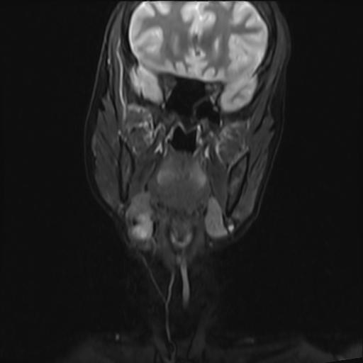 File:Bilateral carotid body tumors and right jugular paraganglioma (Radiopaedia 20024-20060 Coronal 36).jpg