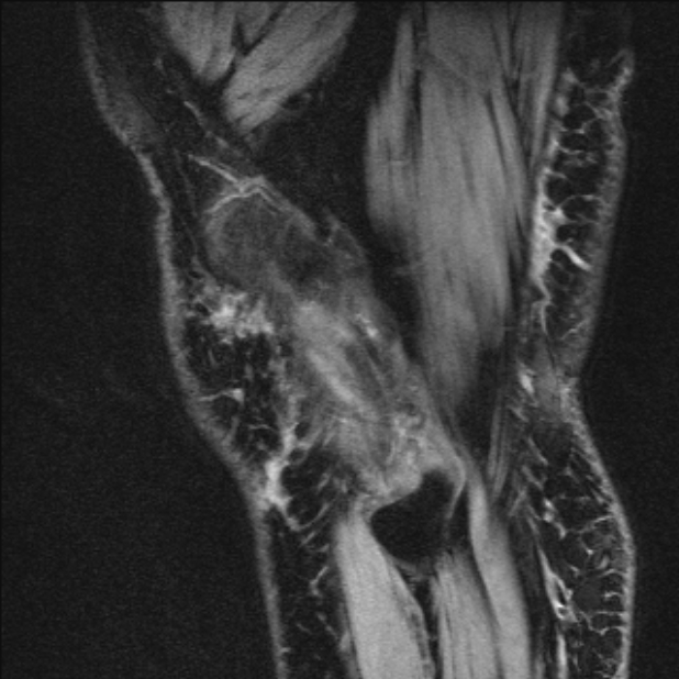 Bilateral focal pigmented villonodular synovitis (Radiopaedia 67643-77046 G 58).jpg