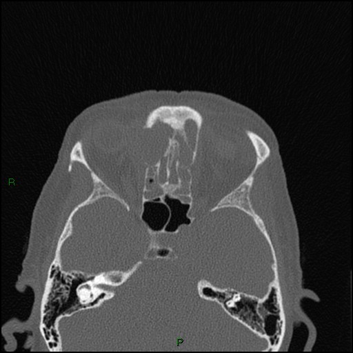 Bilateral frontal mucoceles (Radiopaedia 82352-96454 Axial bone window 131).jpg