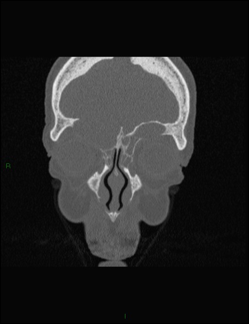 Bilateral frontal mucoceles (Radiopaedia 82352-96454 Coronal 85).jpg