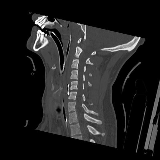 Bilateral locked facets (Radiopaedia 33850-35023 Sagittal bone window 26).png