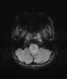 Bilateral mesial temporal polymicrogyria (Radiopaedia 76456-88181 Axial SWI 5).jpg