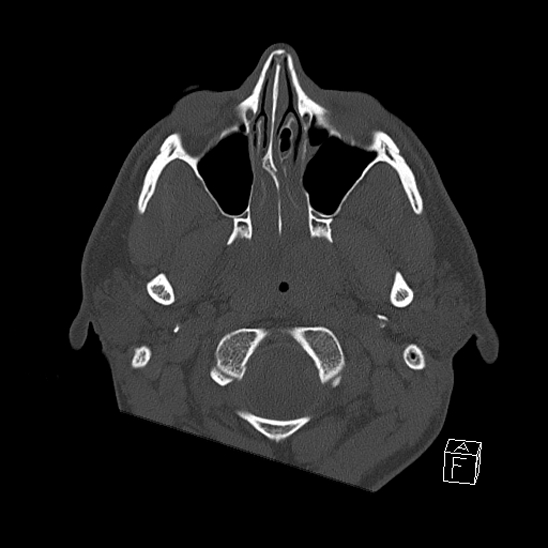 Bilateral occipital condyle fracture (type 2) (Radiopaedia 87675-104089 Axial bone window 8).jpg