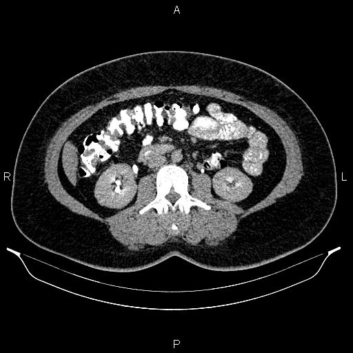 Bilateral ovarian dermoid cysts (Radiopaedia 85785-101603 Axial C+ delayed 35).jpg