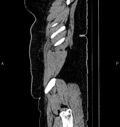Bilateral ovarian dermoid cysts (Radiopaedia 85785-101603 D 93).jpg