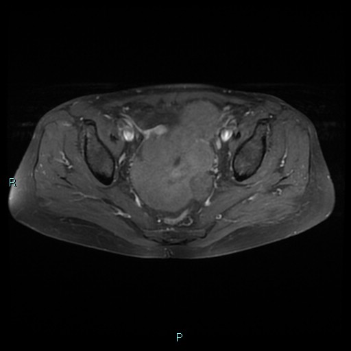 File:Bilateral ovarian fibroma (Radiopaedia 44568-48293 Axial T1 C+ fat sat 15).jpg