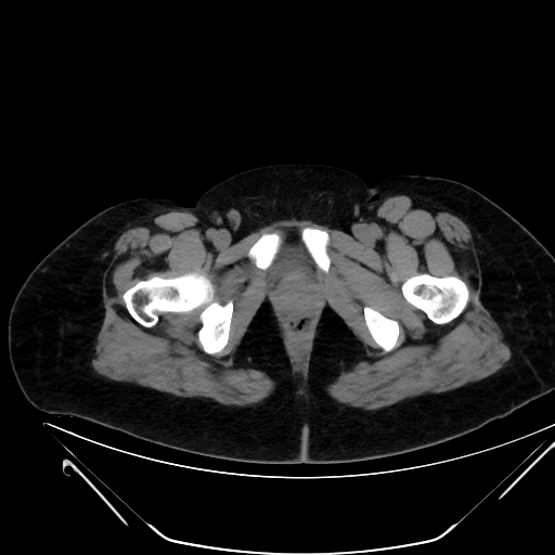 File:Bilateral ovarian mature cystic teratomas (Radiopaedia 79373-92457 Axial non-contrast 94).jpg