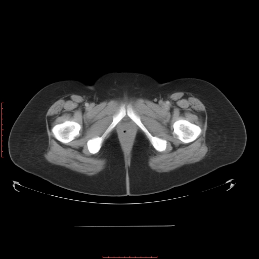 File:Bilateral ovarian serous cystadenocarcinoma with right ovarian torsion (Radiopaedia 32640-33611 A 45).jpg