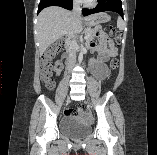 File:Bilateral ovarian serous cystadenocarcinoma with right ovarian torsion (Radiopaedia 32640-33611 B 20).jpg