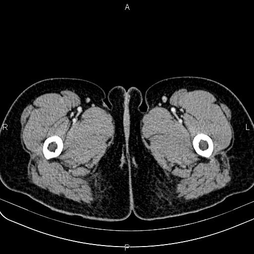 Bilateral ovarian teratoma (Radiopaedia 83131-97503 Axial With contrast 102).jpg