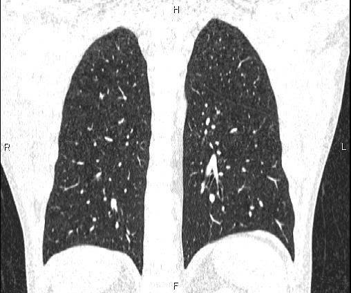 File:Bilateral pulmonary AVM (Radiopaedia 83134-97505 Coronal lung window 58).jpg