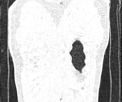 Bilateral pulmonary AVM (Radiopaedia 83134-97505 Coronal lung window 75).jpg