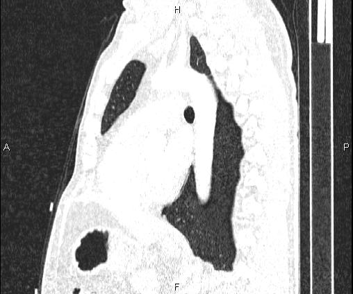 File:Bilateral pulmonary AVM (Radiopaedia 83134-97505 Sagittal lung window 67).jpg