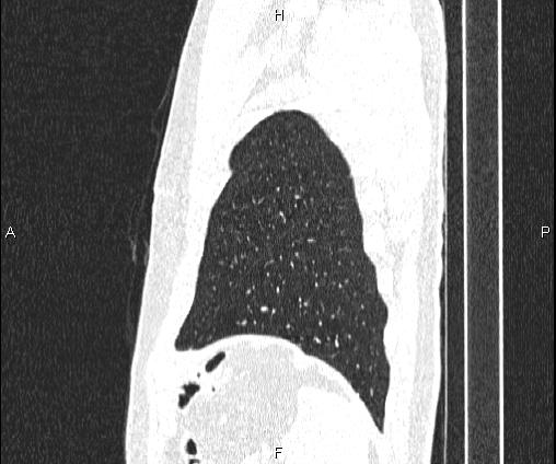 Bilateral pulmonary AVM (Radiopaedia 83134-97505 Sagittal lung window 99).jpg