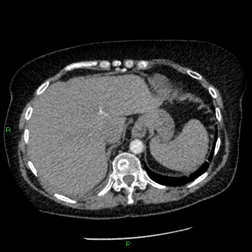 Bilateral pulmonary emboli (Radiopaedia 32700-33669 Axial C+ CTPA 95).jpg