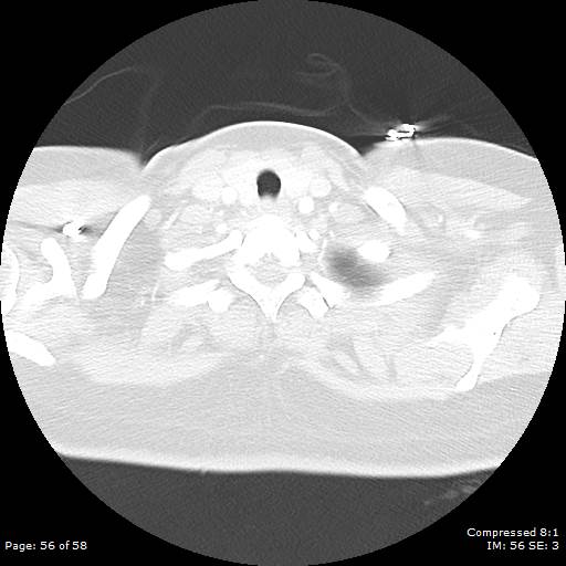 Bilateral pulmonary emboli with Hampton hump sign (Radiopaedia 54070-60246 Axial lung window 56).jpg
