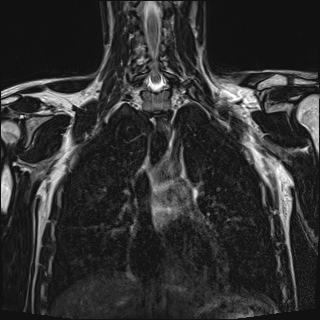 Bilateral spinoglenoid notch ganglion cysts (Radiopaedia 29577-30082 Coronal T2 62).jpg