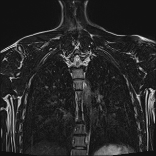 Bilateral spinoglenoid notch ganglion cysts (Radiopaedia 29577-30082 Coronal T2 97).jpg