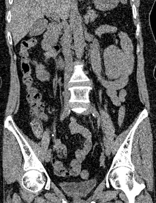 Bilateral staghorn calculi (Radiopaedia 59475-66842 Coronal non-contrast 57).jpg