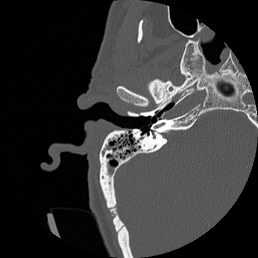 File:Bilateral temporal bone fractures (Radiopaedia 29482-29970 Axial non-contrast 10).jpg