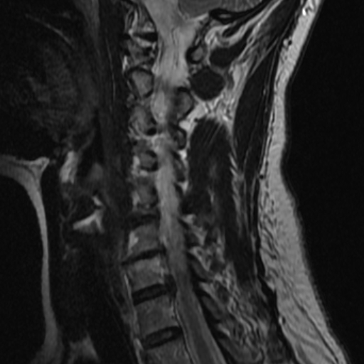 File:Bilateral tortuous vertebral arteries (Radiopaedia 19070-19039 Sagittal T2 6).jpg