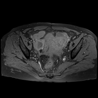 Bilateral tubo-ovarian abscesses (Radiopaedia 58635-65829 Axial T1 fat sat 21).jpg