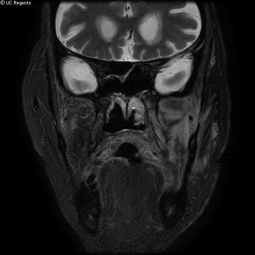 File:Bisphosphonate-related osteonecrosis of the maxilla (Radiopaedia 51367-57101 Coronal T2 fat sat 14).jpg