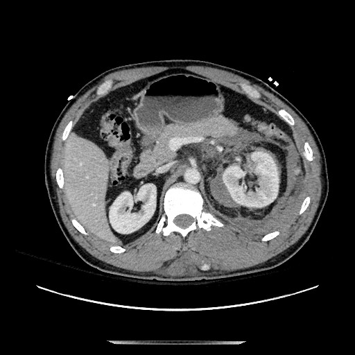 Blunt abdominal trauma with solid organ and musculoskelatal injury with active extravasation (Radiopaedia 68364-77895 A 47).jpg