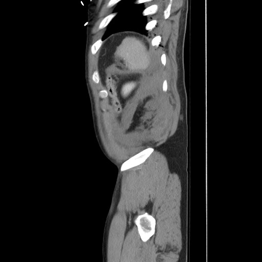File:Blunt abdominal trauma with solid organ and musculoskelatal injury with active extravasation (Radiopaedia 68364-77895 C 126).jpg