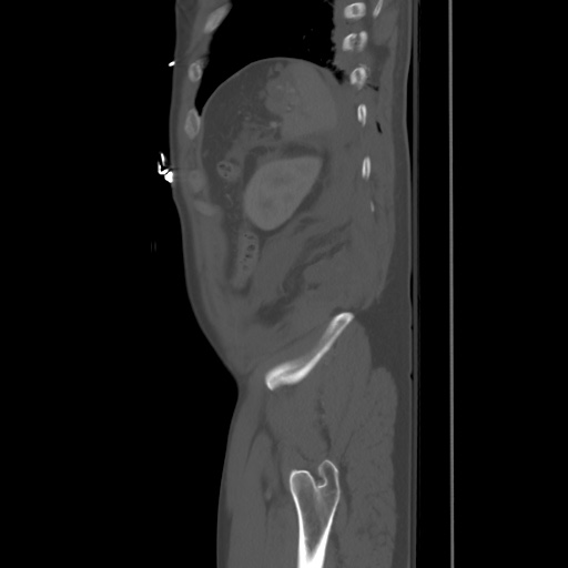 Blunt abdominal trauma with solid organ and musculoskelatal injury with active extravasation (Radiopaedia 68364-77895 Sagittal bone window 95).jpg