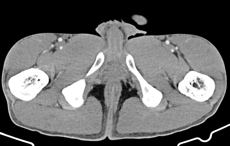 Blunt injury to the small bowel (Radiopaedia 74953-85987 A 208).jpg