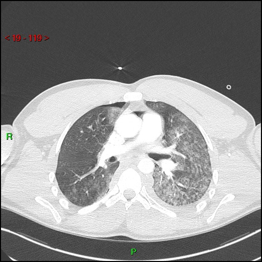 Blunt thoracic trauma (Radiopaedia 73454-84221 Axial lung window 44).jpg