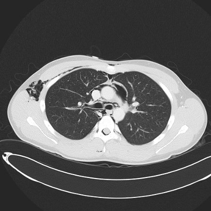 Boerhaave syndrome with mediastinal, axillary, neck and epidural free gas (Radiopaedia 41297-44115 Axial lung window 44).jpg