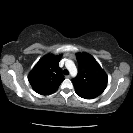 File:Borderline mucinous tumor (ovary) (Radiopaedia 78228-90808 A 14).jpg