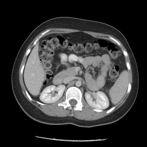 File:Borderline mucinous tumor (ovary) (Radiopaedia 78228-90808 A 80).jpg