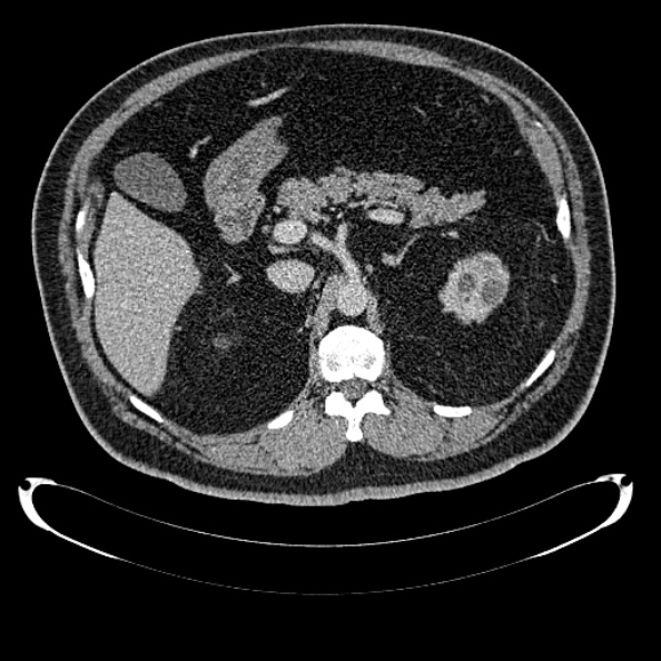 Bosniak renal cyst - type IV (Radiopaedia 24244-24518 C 105).jpg