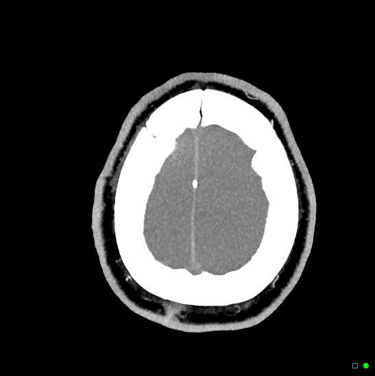 Brain death on MRI and CT angiography (Radiopaedia 42560-45841 B 8).jpg