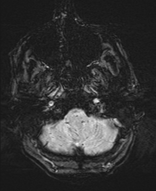 Brain metastases - lung cancer primary (Radiopaedia 75060-86115 Axial SWI 9).jpg